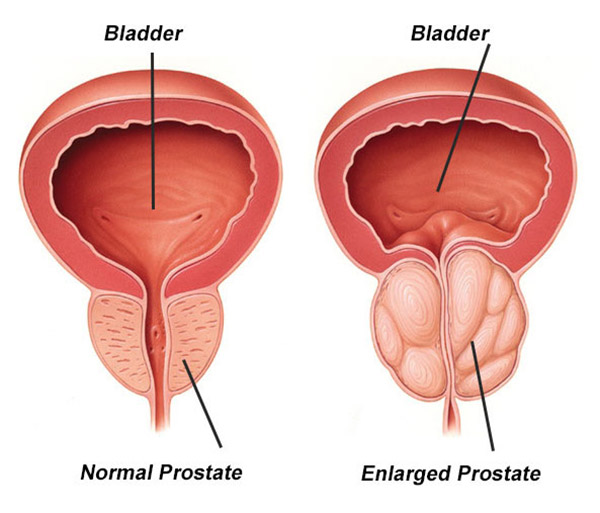 Prostate Anatomy Comparison